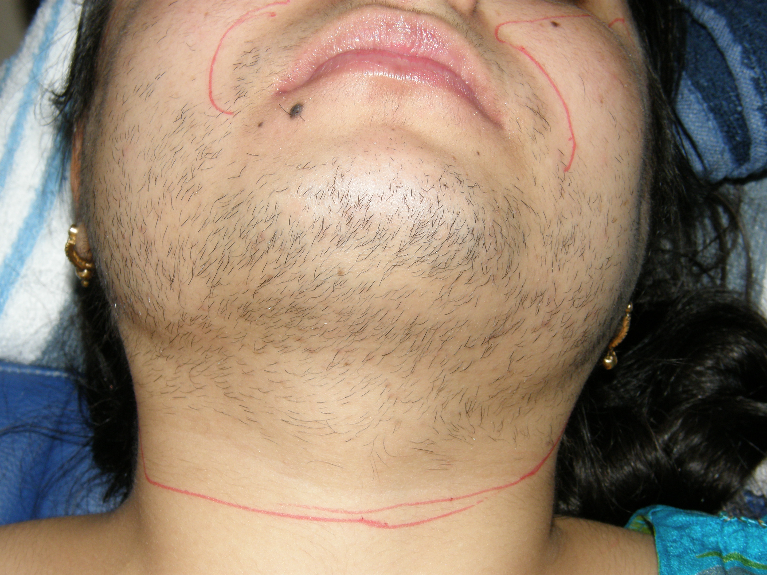 laser-touch-hair-removal-clinic-amritsar-results